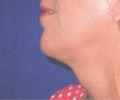 Chin Surgery - After