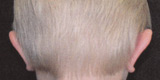 Cosmetic Ear Surgery - After