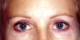 Eyelid Surgery - Before