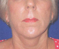 Facelift - After