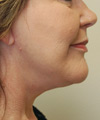 Facelift - After