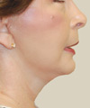 Facelift - After