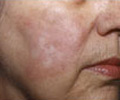Laser Surgery - After
