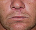 Skin Cancer - After
