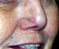 Skin Cancer - After
