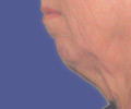 Facelift - Before