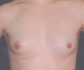 Cosmetic Breast Surgery - Before