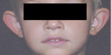 Cosmetic Ear Surgery - Before