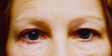 Eyelid Surgery - Before
