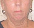 Facelift - Before