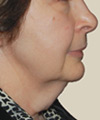 Facelift - Before