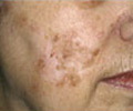 Laser Surgery - Before
