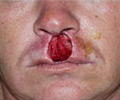 Skin Cancer - Before
