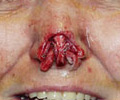Skin Cancer - Before